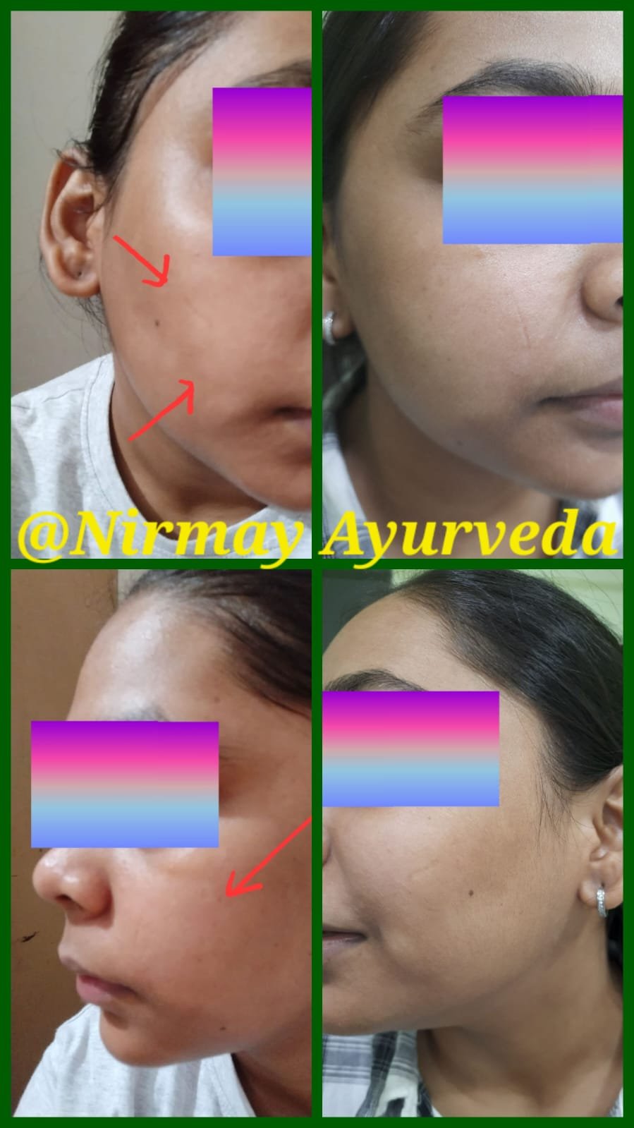 Skin Treatment Before After